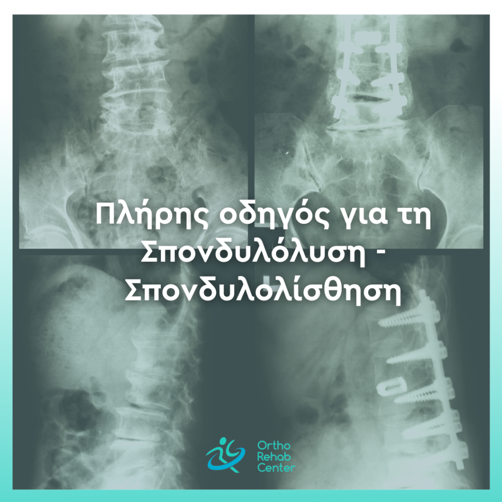 Πλήρης οδηγός για την Σπονδυλολυση cover