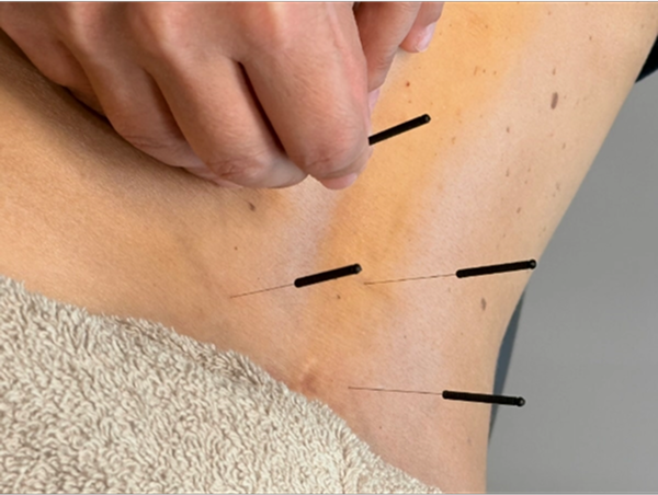 βελόνες βελονισμού τοποθετημένες κοντα στην περιοχή της μέσης.